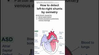 How to detect lefttoright cardiac shunts by oximetry [upl. by Lawley]