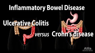 Ulcerative Colitis versus Crohns Disease Animation [upl. by Ephrayim]