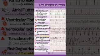 Sinus rhythm sinus tachycardia atrial fibrillation ventricular fibrillation heart block [upl. by Mayda]