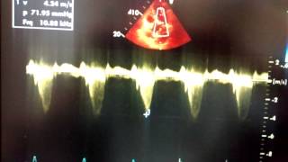 HYPETROPHIC CARDIOMYOPATHY WITH DYNAMIC LVOT OBSTRUCTION [upl. by Moon]