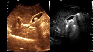 Cholelithiasis  Cholesterol specks  Grade 3 Fatty Liver  Cholesterolosis [upl. by Dunseath]