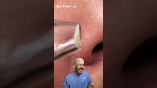 I wouldn’t recommend a pore vacuum 🛑 credit zudaifuarturo on TT doctor satisfying viral [upl. by Stichter]