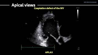 〖Echocardiography〗 Dilated CMP  Myocarditis [upl. by Nosduh303]