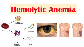 Hemolytic Anemia [upl. by Uohk]