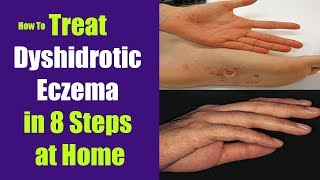 How to Treat Dyshidrotic Eczema in 8 Steps at Home [upl. by Yenffad21]