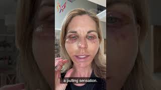 My Advanced Facelift Recovery Day by Day  Real Stories By Real Patients 2022 [upl. by Aihsekat16]