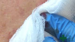 Removal of a superficial Epidermal Cyst with Minimal Rupture [upl. by Hendrick]