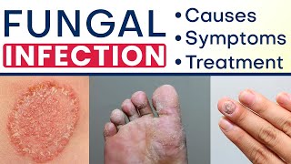 ✅ Fungal Infection क्या और कैसे होता है ✅ Fungal Infection Symptoms Causes and Treatment in Hindi [upl. by Bick]