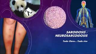 SARCOIDOSIS Y NEUROSARCOIDOSIS Todo claro todo rico [upl. by Wurster]