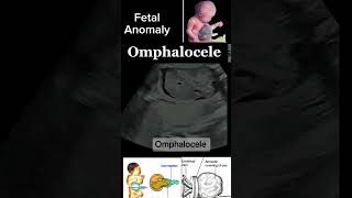 Prenatal Imaging of Omphalocele A Detailed Case Study casestudy anomally shorts DrSaimakhan [upl. by Warrick181]