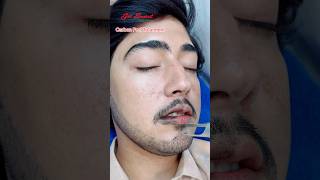 Carbon Peel Laser Treatment getsmarthairclub viralvideo beauty laserhairtreatment laser [upl. by Norrad]