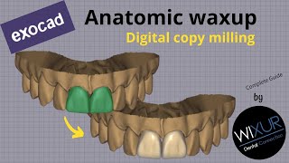 exocad Anatomic Waxup digital copy milling [upl. by Kenlay]