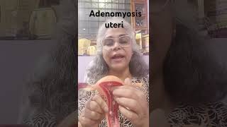 Adenomyosis of uterus health इनफॉर्मेशन [upl. by Ecirtram]