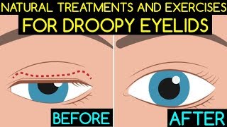 Natural Treatments and Exercises For Droopy Eyelids [upl. by Sybyl]