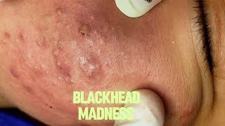 Most Satisfying Blackhead amp Acne Removal Deep Face Cleansing Compilation 54 [upl. by Sachs175]