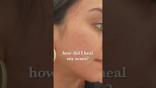 Healing my acne scars before and after results [upl. by Glass]