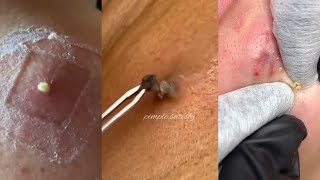 41 Minutes Of Top ASMR Pimple Popping Video [upl. by Ivel]