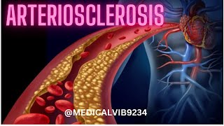 WHAT IS THE ARTERIOSCLEROSIS [upl. by Casilda]