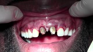 Clinical Crown Lengthening 611 Revision of Previous ST Gingivectomy [upl. by Myer]