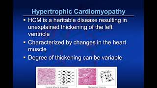 Pediatric Cardiomyopathy 101 [upl. by Aicetal]