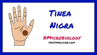 Tinea Nigra  Microbiology [upl. by Norab]