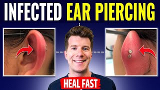 Doctor explains HOW TO RECOGNIZE AND TREAT INFECTED EAR PIERCING [upl. by Acissey]