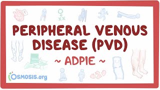 Peripheral venous disease PVD Nursing Process ADPIE [upl. by Pasquale]