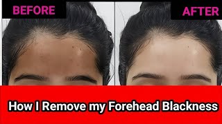 How I Removed my Forehead Blackness  Blackforehead Styleyrself [upl. by Boswall]