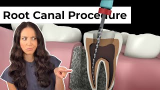 Root Canal Procedure Step by Step [upl. by Oicnerolf248]