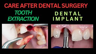 INSTRUCTIONS AFTER DENTAL SURGERY  TOOTH EXTRACTION  DENTAL IMPLANT  PRECAUTIONS OF ORAL SURGERY [upl. by Landri372]