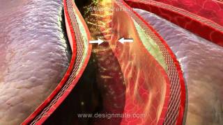 Assista a aula sobre Aterosclerose simulada na nova Lousa 3D Estereoscópico [upl. by Je]