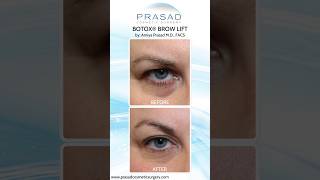 How the Botox Brow Lift Works botox [upl. by Lawlor672]