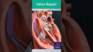 Valve Repair  Mitral Valve Repair  shorts heart youtubeshorts [upl. by Aderfla]