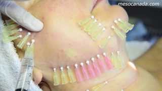 Thread Lifting 4D Mesotherapy [upl. by Ahtamat]