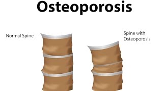 What is Osteoporosis [upl. by Htebirol]