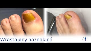 Po usuwaniu wrastającego paznokcia  wizyta kontrolna  After ingrown nail removal  control visit [upl. by Tshombe]