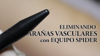 Eliminar Arañas Vasculares o Telangiectasia con Termocoagulación Equipo Spider [upl. by Oidiple]