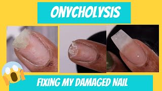 Onycholysis Uuggghh I damaged my nail  Fixing my separated damaged nail [upl. by Betz]