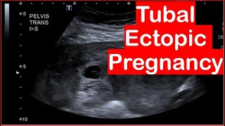 Ultrasound Diagnosis Of Tubal ectopic pregnancy [upl. by Diarmuid29]