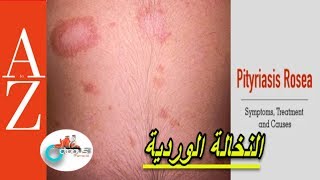 Pityriasis Rosea From A to Z  النخالة الوردية  اعراضها واسبابها  تطور المرض  كل اربعاء [upl. by Ayela257]