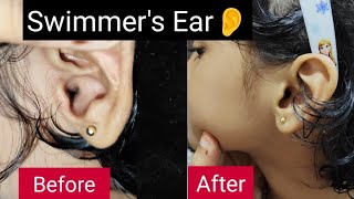 What is Swimmers Ear Ear Pain Treating Swimmers Ear  Treating Swimmers Ear rid of swimmer’s ear [upl. by Dorian285]