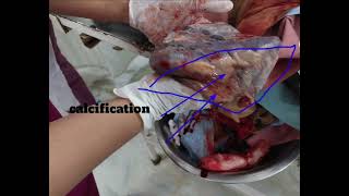 calcification of plecenta  midwifery nursingofficer mbbs education [upl. by Asher259]