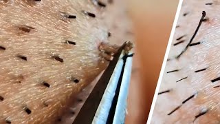 Ingrown hair removal compilation😌 [upl. by Hgielyk]