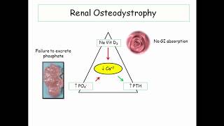 12DaysinMarch Renal Osteodystrophy for the USMLE Step One [upl. by Komarek]