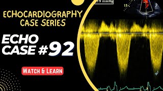 ECHO CASE 92  Echocardiography for Beginners  Echocardiogram Interpretation  2D Echo Basics [upl. by Kelli]