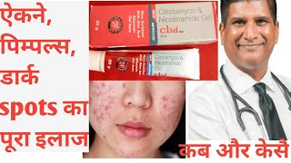 clid gel  clindamycin amp nicotinamide gel  best for acne pimple dark spotopen pores [upl. by Oner]