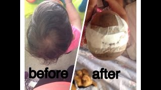 Sagittal CraniosynostosisRyKs Journey [upl. by Yrahca]