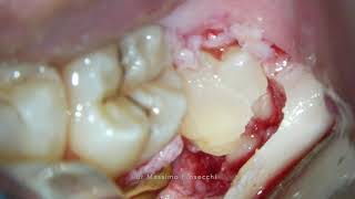 Impacted third molar and supernumerary extractions [upl. by Burnight]