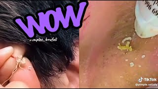 Top Satisfying Pimple Pops of 2024 Blackheads Cysts and More [upl. by Yramesor]