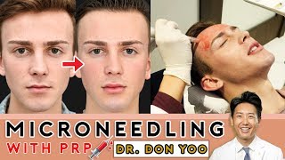 Microneedling with PRP  Vampire Facial  Beverly Hills [upl. by Kepner]